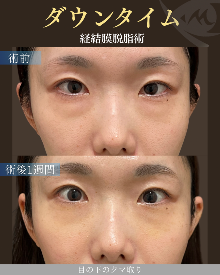 30代女性  経結膜脱脂術 ダウンタイム